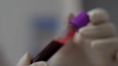 Testul Galleri: Rezultate promițătoare pentru analiza de sânge care poate detecta 50 de tipuri de cancer