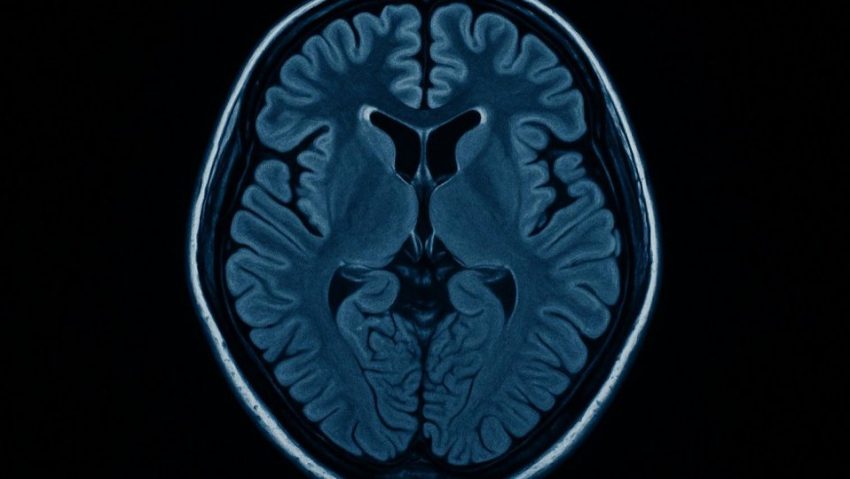 Cercetătorii japonezi au identificat cauza biologică a „ceții cerebrale” post-Covid